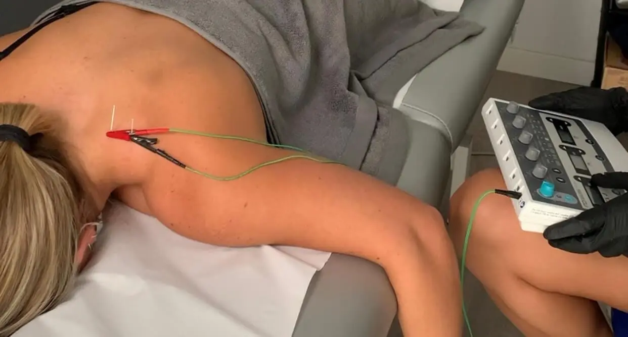Neuromodulación en fisioterapia TMKiné Madrid Neuromodulación en fisioterapia: tratamiento avanzado para el dolor crónico en TMKiné Madrid